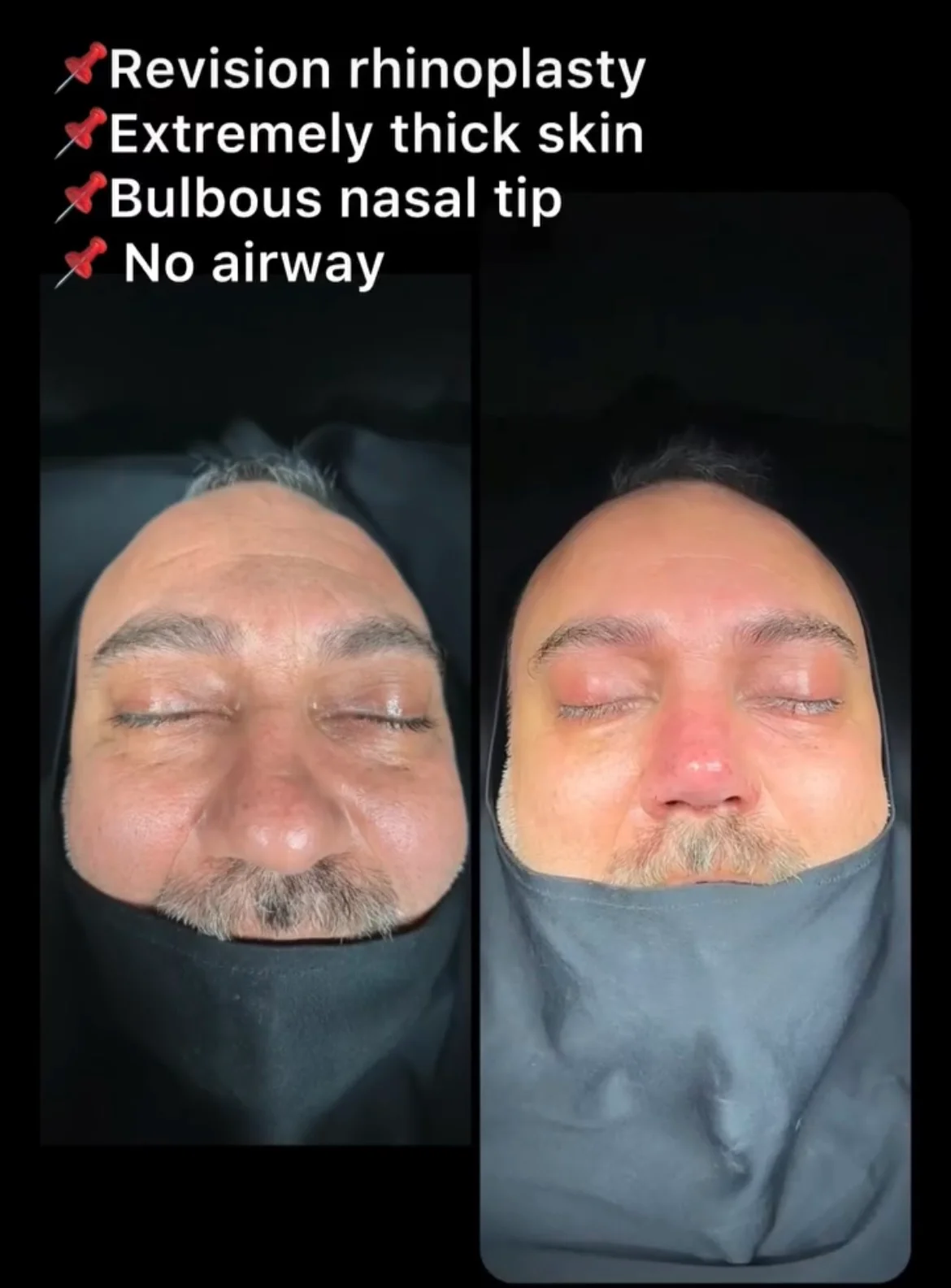 تجميل الأنف للرجال قبل وبعد تجميل الأنف للرجال قبل وبعد