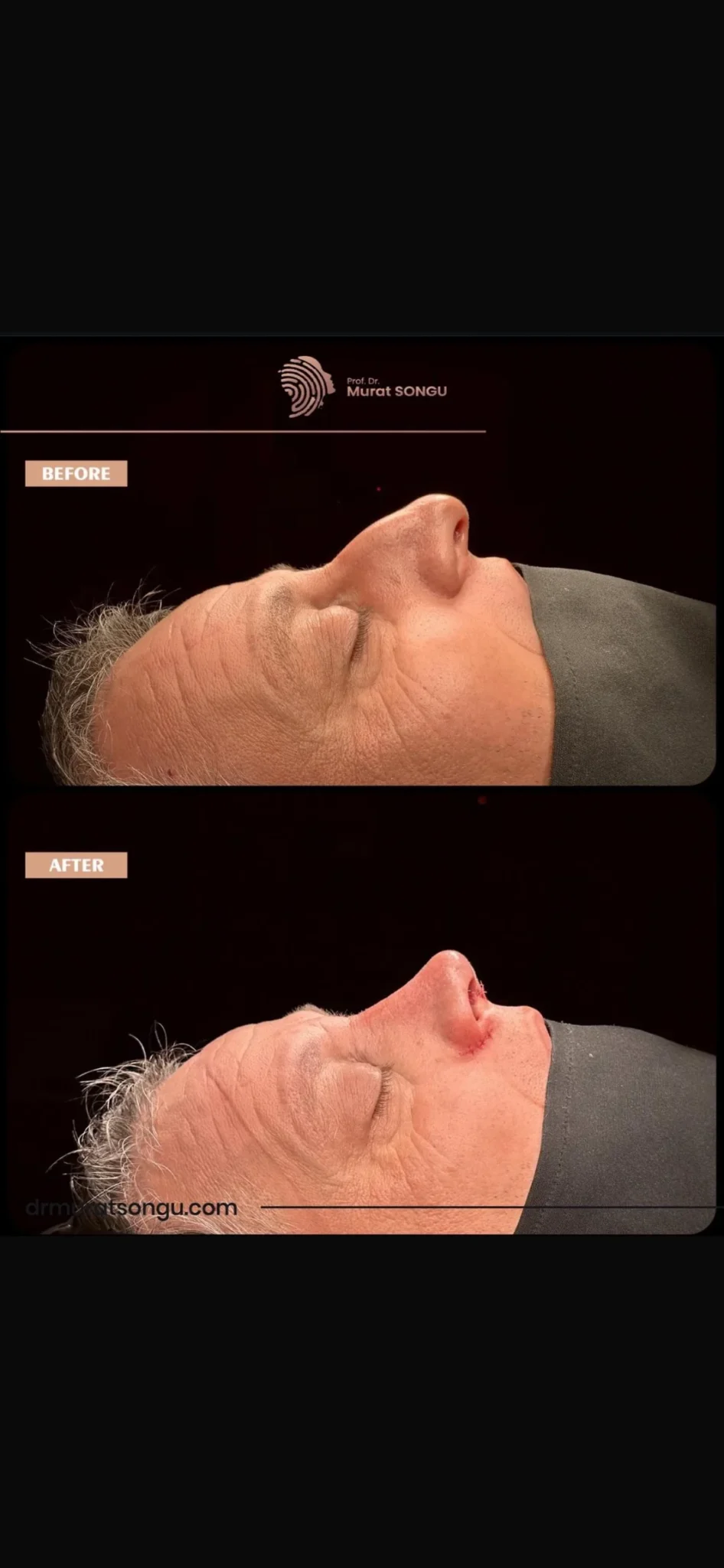تجميل الأنف للرجال قبل وبعد تجميل الأنف للرجال قبل وبعد
