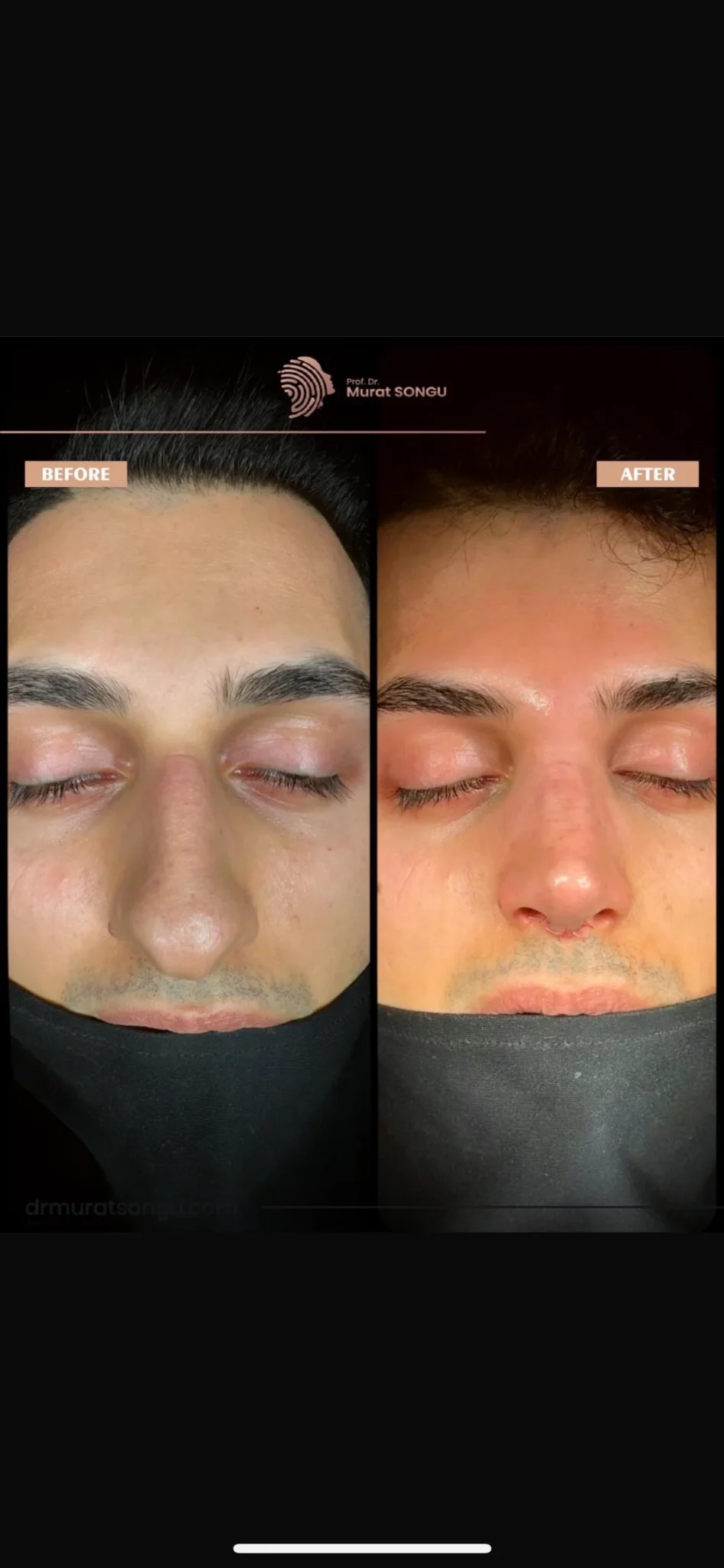 تجميل الأنف للرجال قبل وبعد تجميل الأنف للرجال قبل وبعد