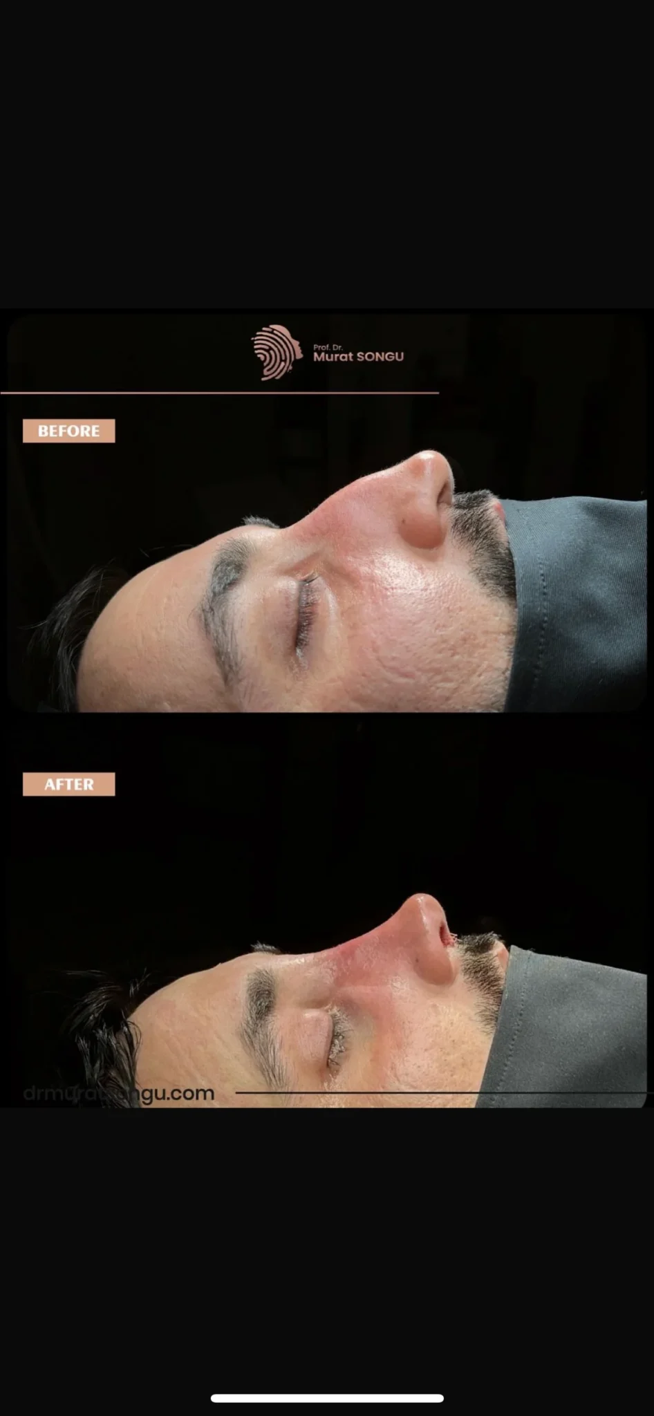 تجميل الأنف للرجال قبل وبعد تجميل الأنف للرجال قبل وبعد