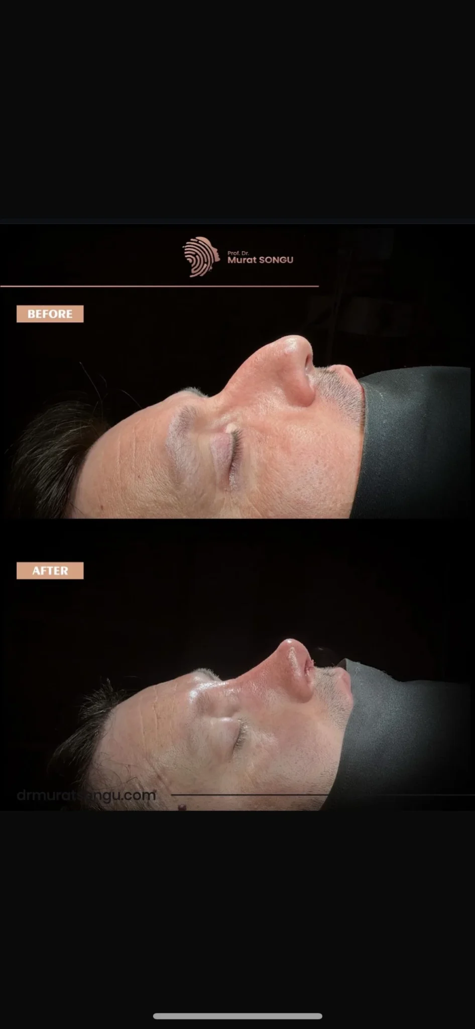 تجميل الأنف للرجال قبل وبعد تجميل الأنف للرجال قبل وبعد