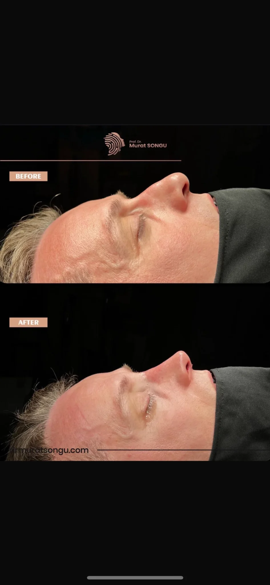 تجميل الأنف للرجال قبل وبعد تجميل الأنف للرجال قبل وبعد