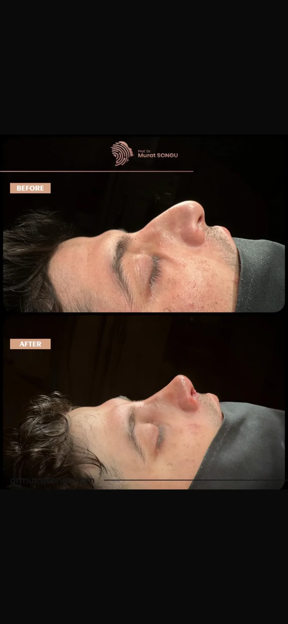 تجميل الأنف للرجال قبل وبعد تجميل الأنف للرجال قبل وبعد