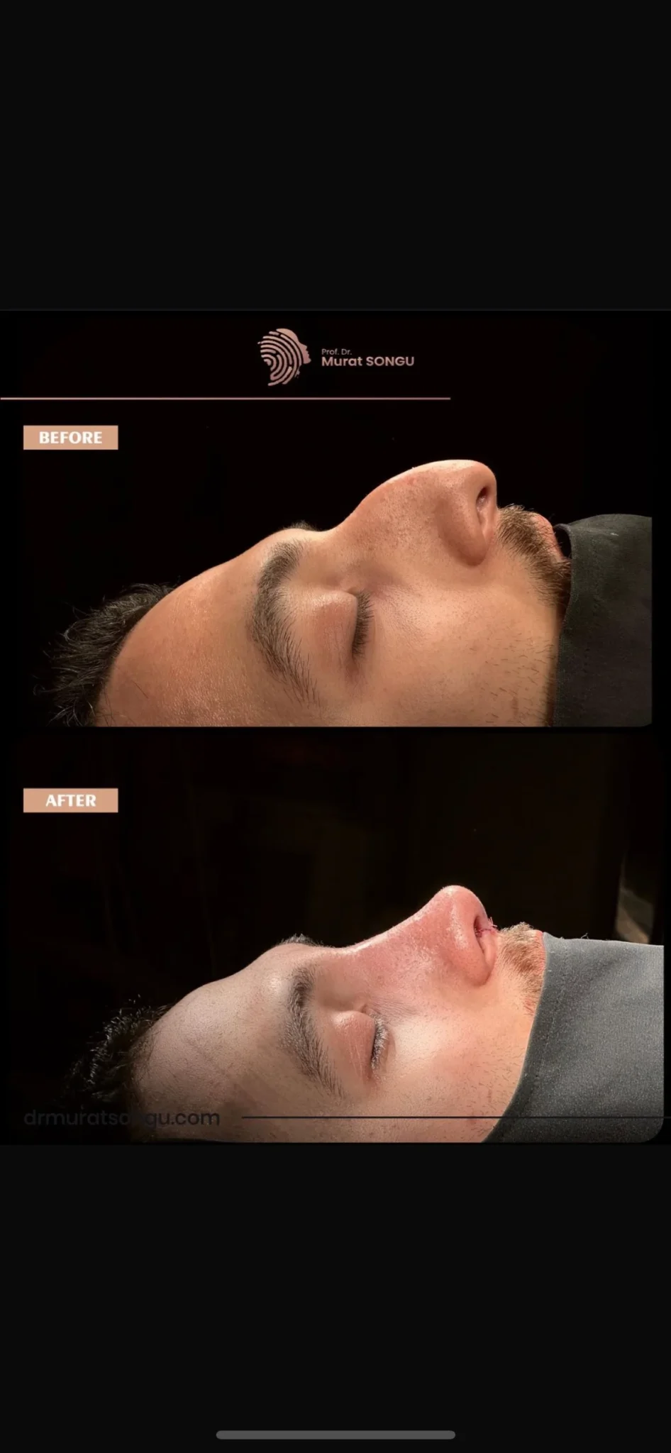 تجميل الأنف للرجال قبل وبعد تجميل الأنف للرجال قبل وبعد