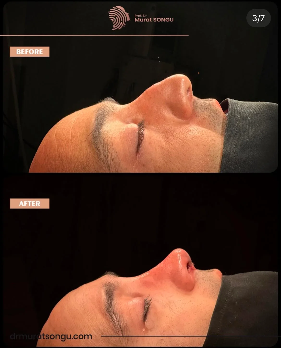 تجميل الأنف للرجال قبل وبعد تجميل الأنف للرجال قبل وبعد