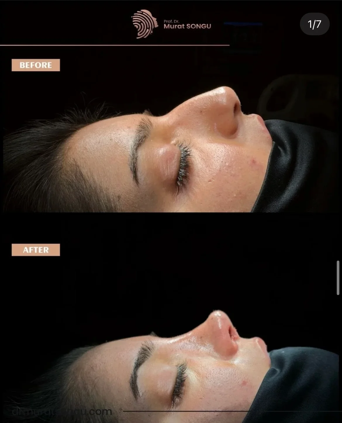 صور قبل وبعد عملية تجميل الأنف للبشرة السميكة صور قبل وبعد عملية تجميل الأنف للبشرة السميكة