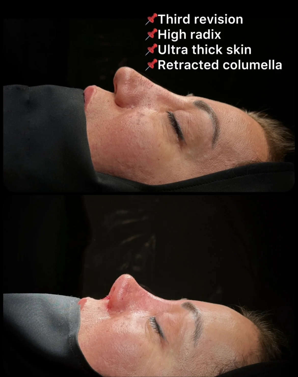 صور قبل وبعد عملية تجميل الأنف للبشرة السميكة صور قبل وبعد عملية تجميل الأنف للبشرة السميكة
