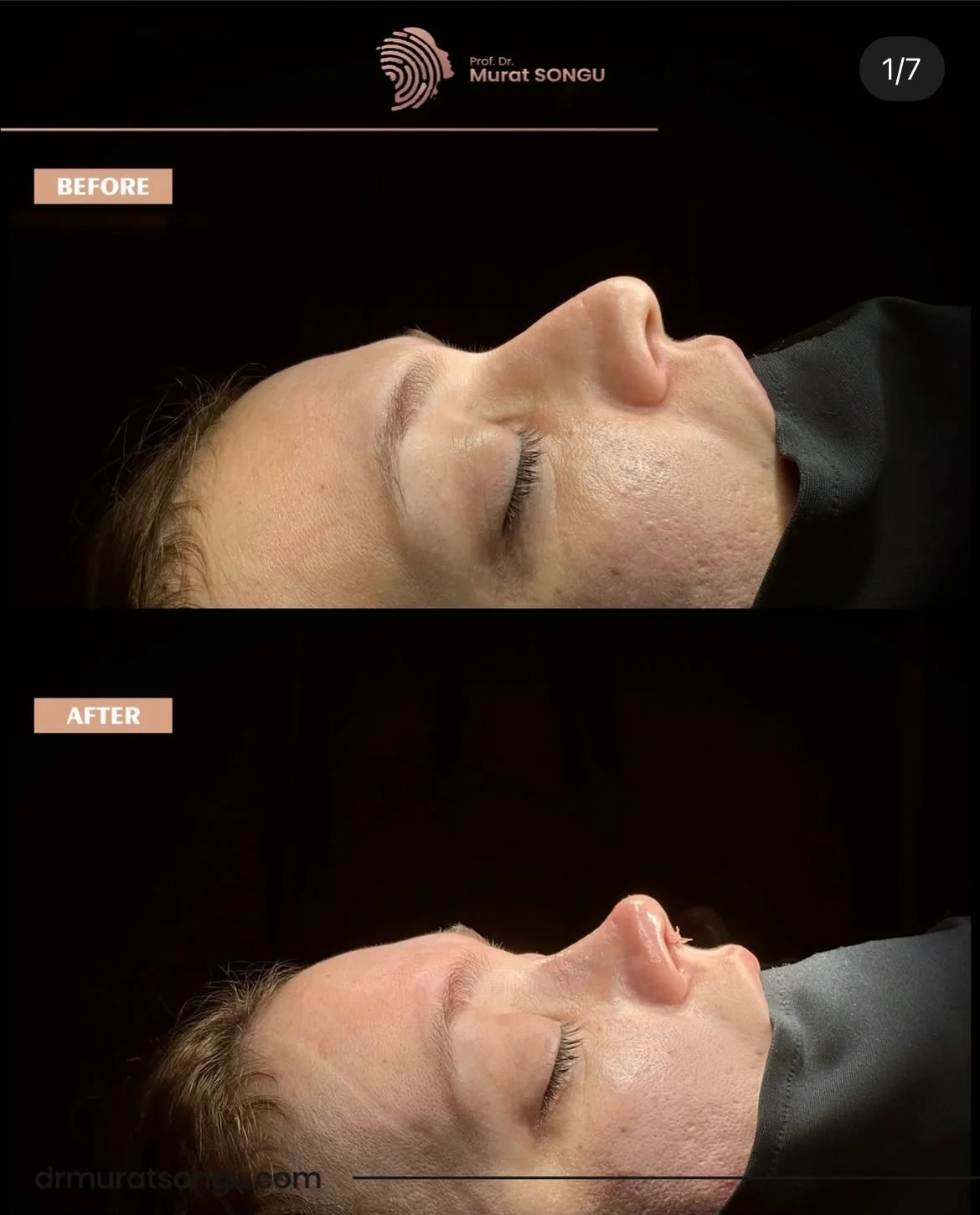 مراجعة تجميل الأنف قبل وبعد