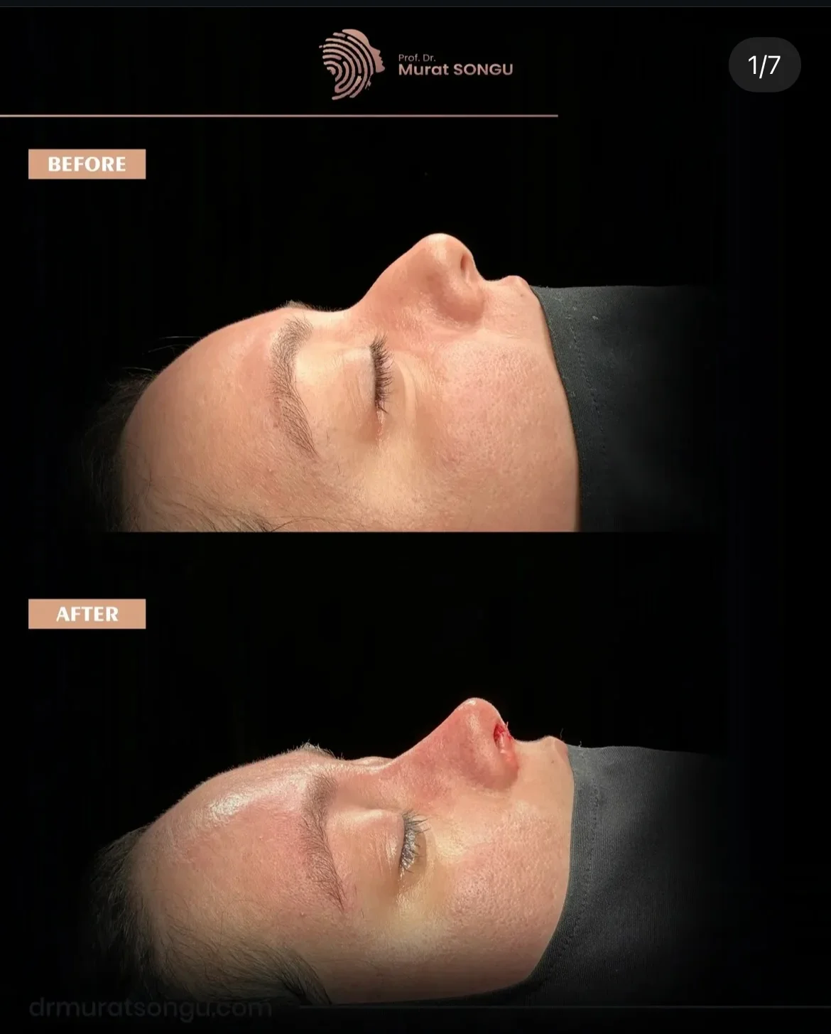 مراجعة تجميل الأنف قبل وبعد