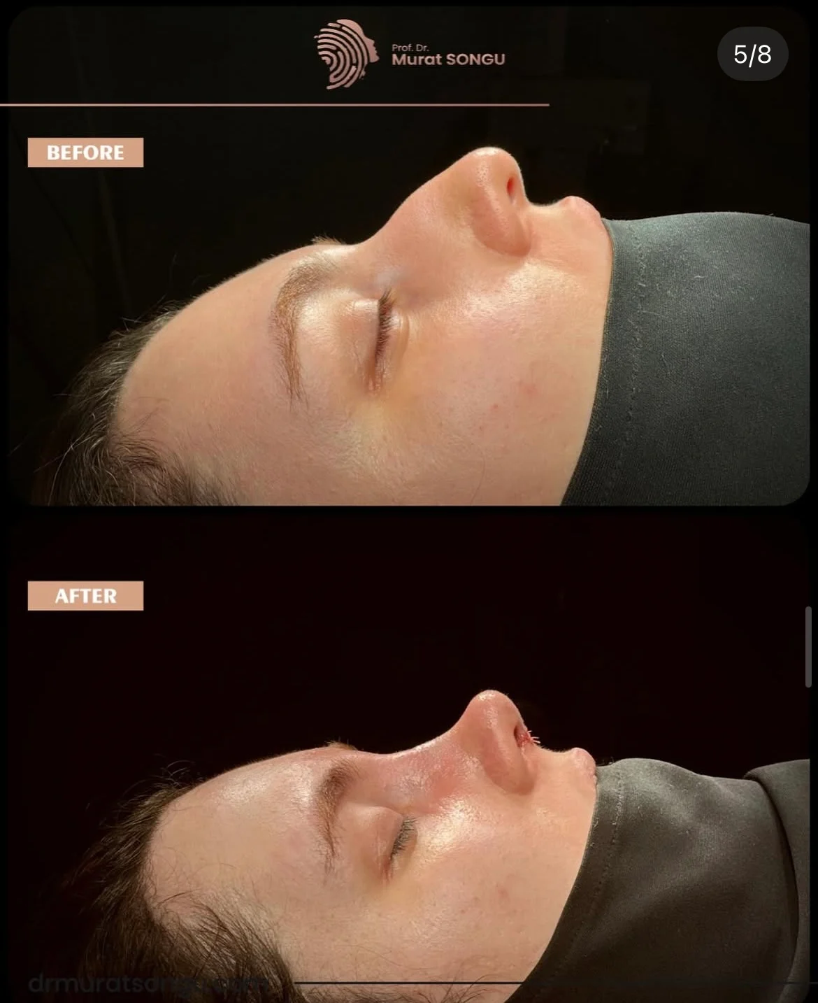 مراجعة تجميل الأنف قبل وبعد