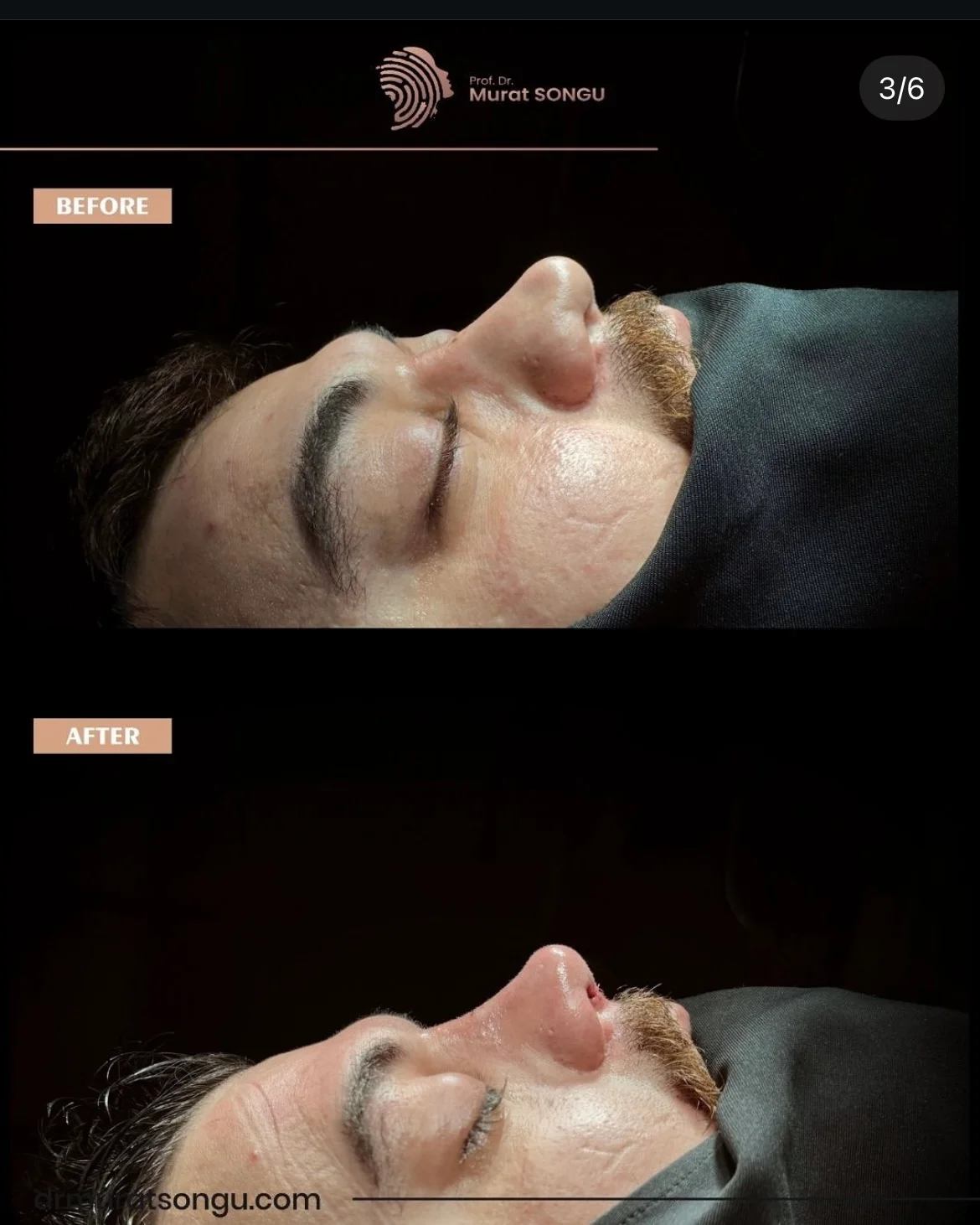 مراجعة تجميل الأنف قبل وبعد