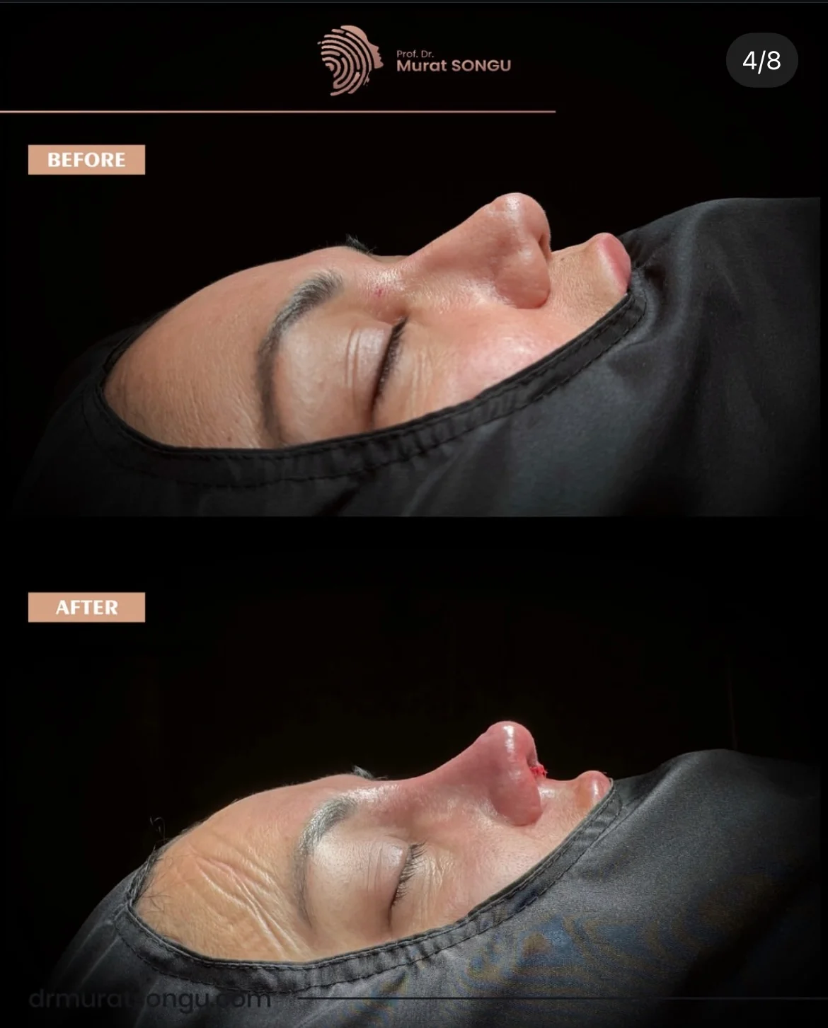 مراجعة تجميل الأنف قبل وبعد