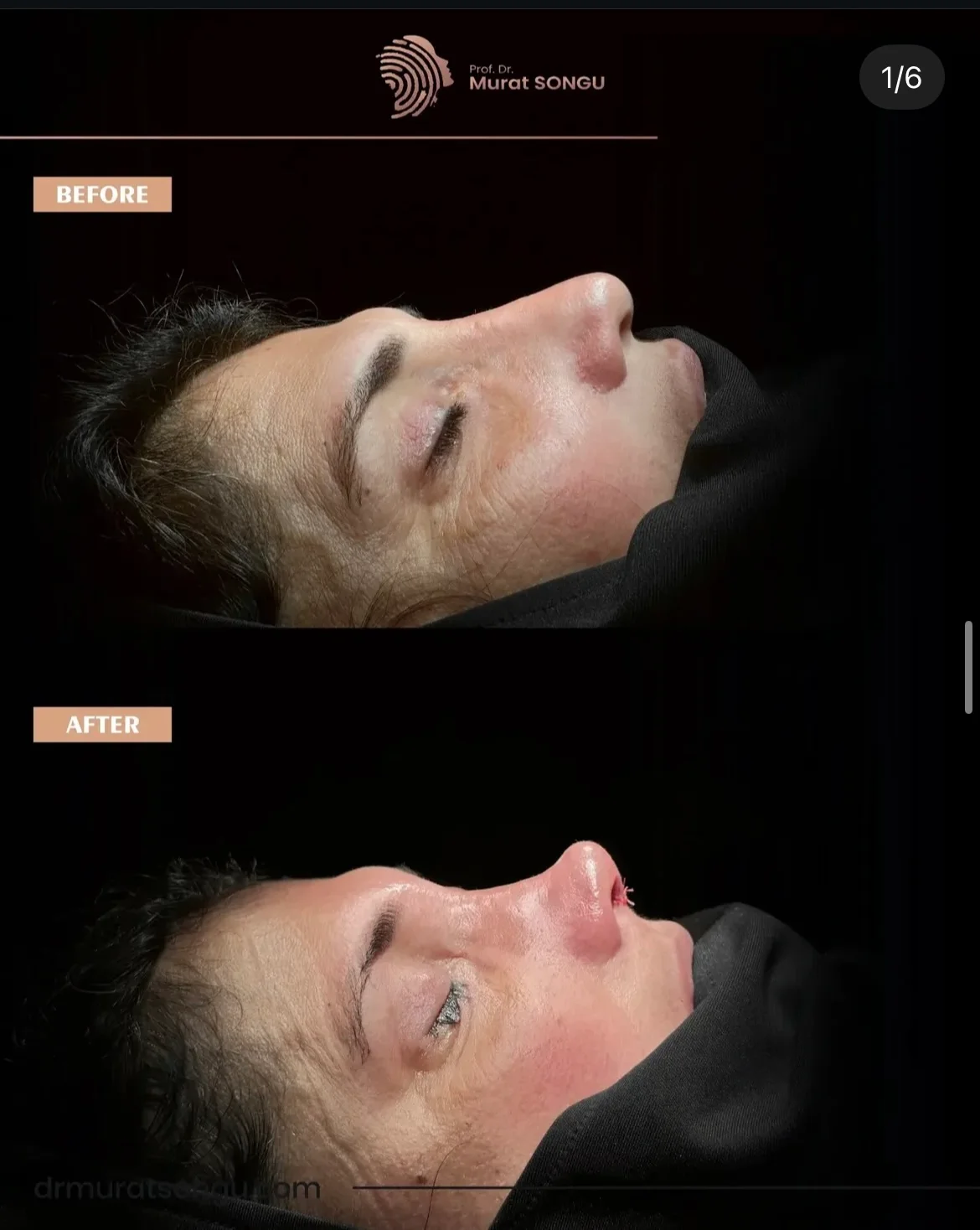 مراجعة تجميل الأنف قبل وبعد