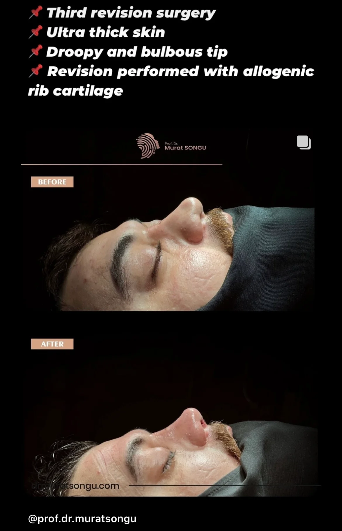 مراجعة تجميل الأنف قبل وبعد