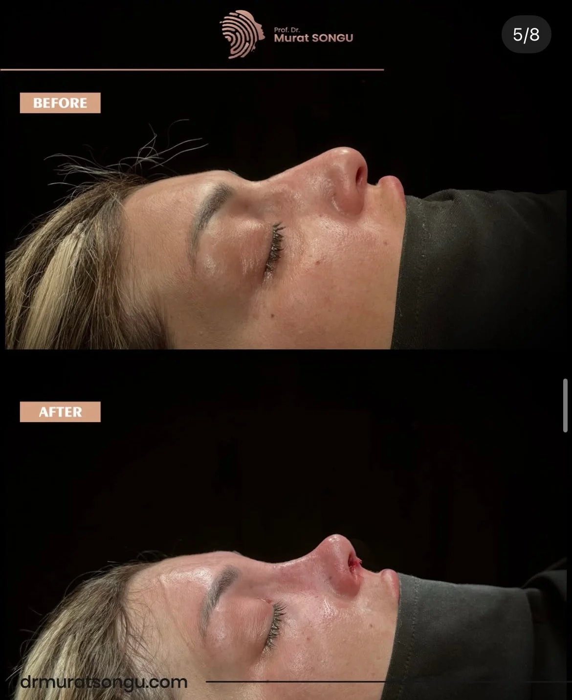 مراجعة تجميل الأنف قبل وبعد