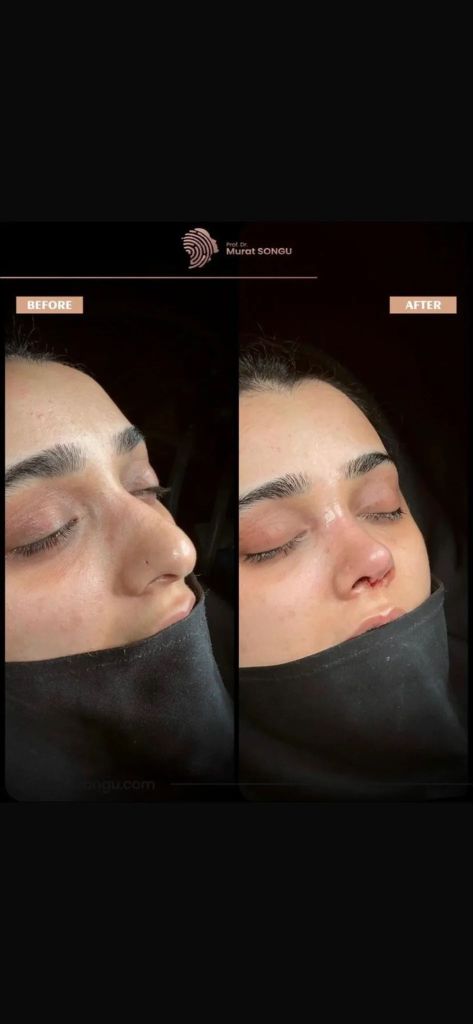 مراجعة تجميل الأنف قبل وبعد