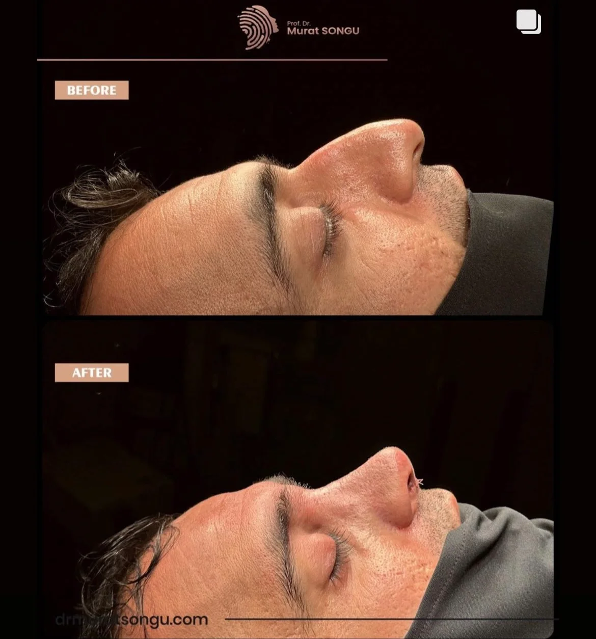 معرض صور قبل وبعد عملية الأنف الأعوج