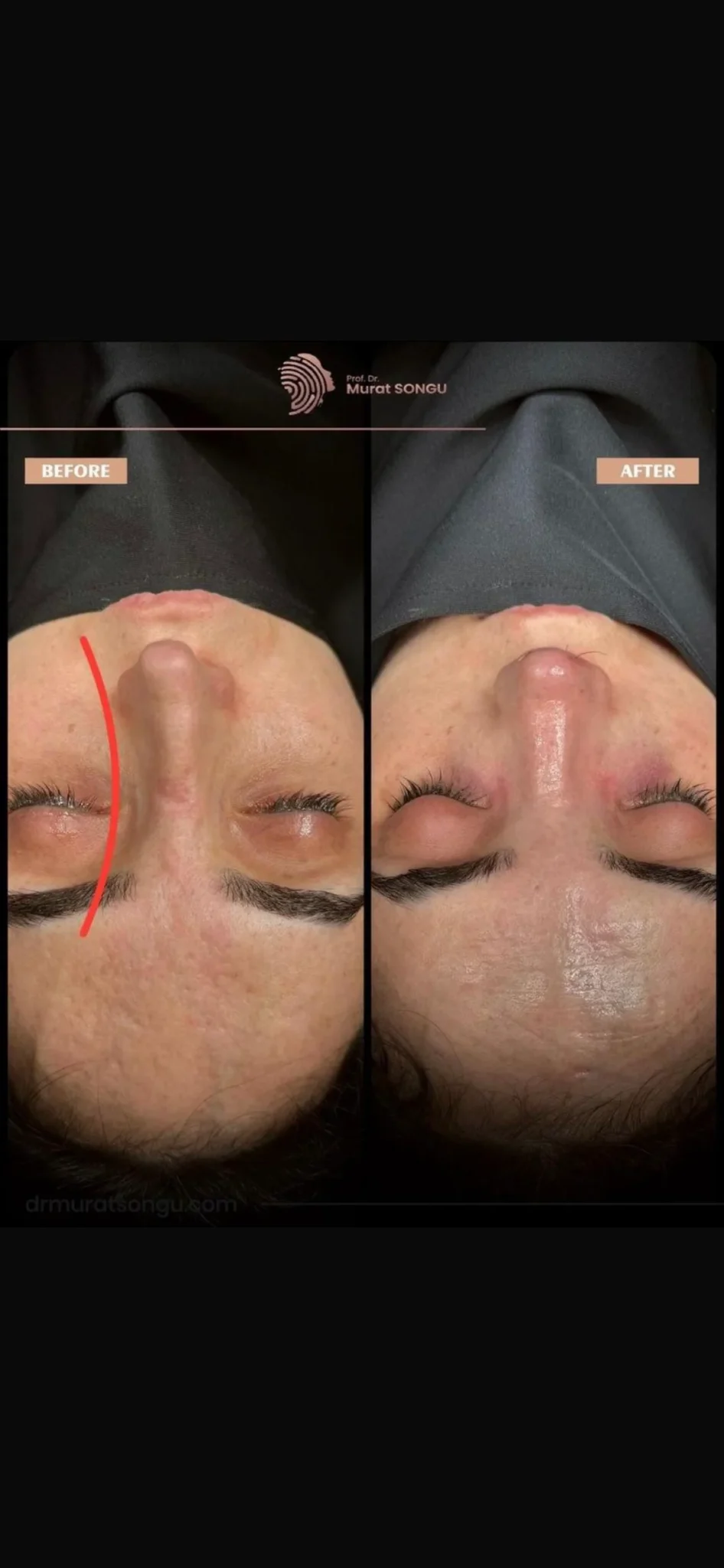 معرض صور قبل وبعد عملية الأنف الأعوج