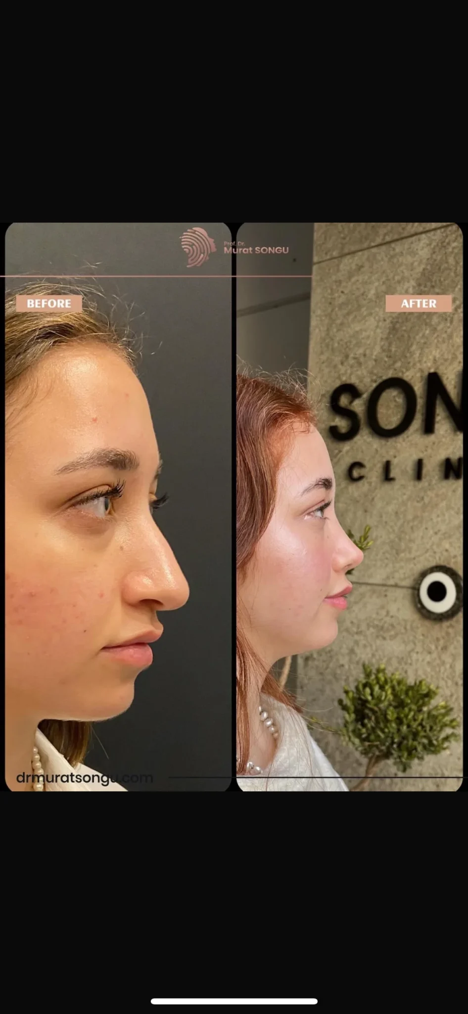 تجميل الأنف الأساسي قبل وبعد تجميل الأنف الأساسي قبل وبعد