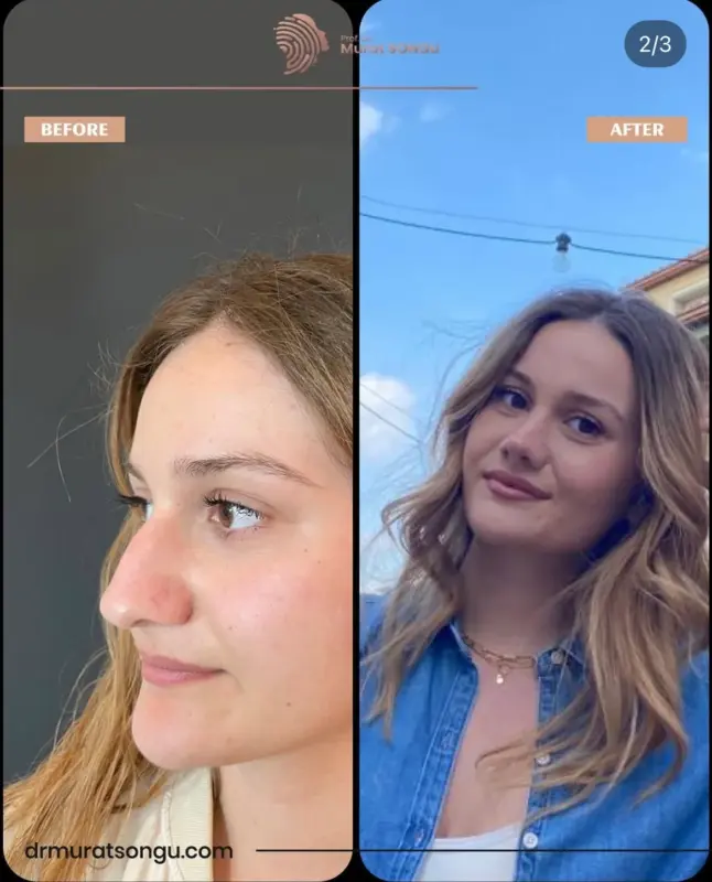 تجميل الأنف الأساسي قبل وبعد مقارنة قبل وبعد لوجه امرأة شابة، تُظهر منظرًا جانبيًا بمظهر طبيعي على اليسار وصورة أمامية مُنسقة مع مكياج وشعر مجعد في الخارج على اليمين