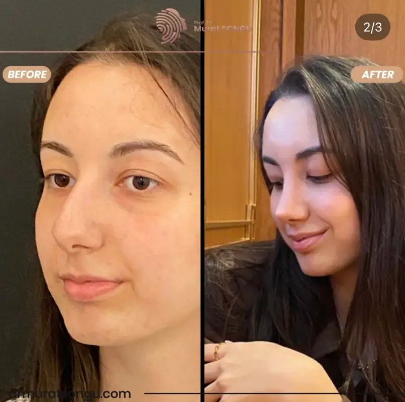 تجميل الأنف الأساسي قبل وبعد مقارنة قبل وبعد لوجه امرأة شابة، تُظهر تحسينًا تجميليًا أو جماليًا طفيفًا مع بشرة أكثر نعومة وتحديد أفضل للوجه على الجانب الأيمن