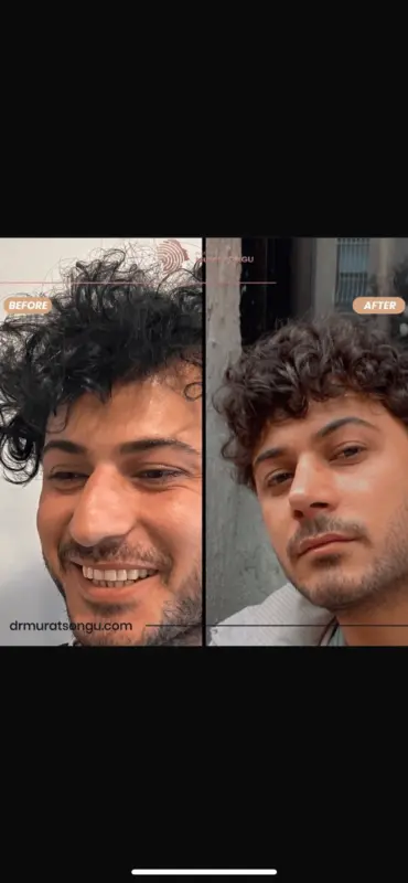تجميل الأنف الأساسي قبل وبعد نتيجة زراعة شعر قبل وبعد تُظهر رجلًا شابًا ذا شعر مجعد، مع تحسن كثافة خط الشعر وتجعدات أكثر امتلاءً وطبيعية بعد العلاج على يد الدكتور مراد سونغو