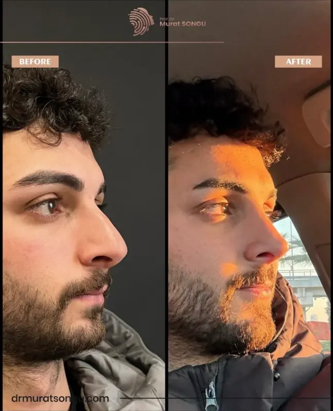 تجميل الأنف الأساسي قبل وبعد مقارنة جانبية قبل وبعد لتجميل الأنف لدى رجل تُظهر تحسن جسر الأنف وصقل طرفه على يد البروفيسور الدكتور مراد سونغو