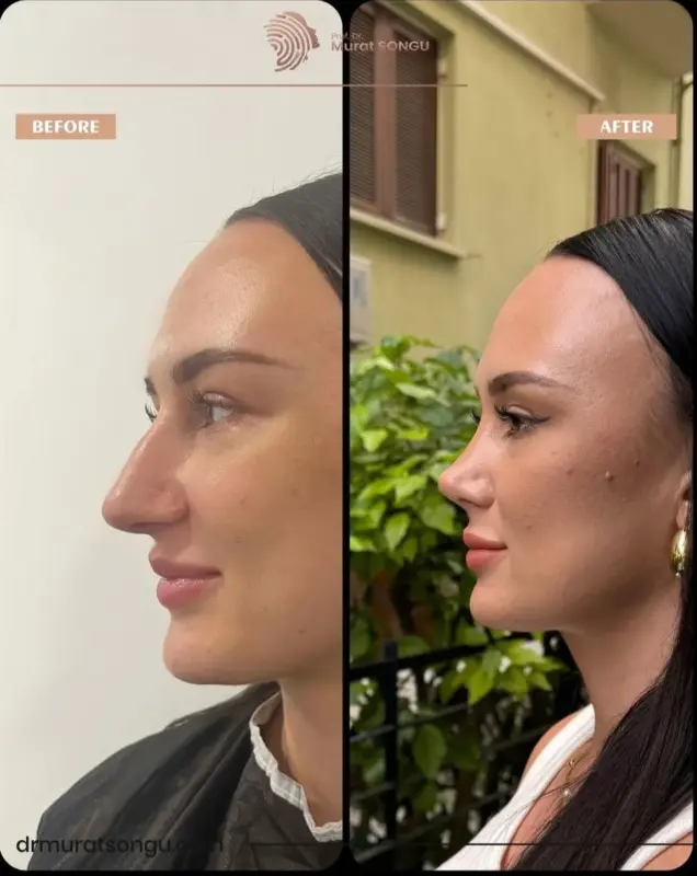 تجميل الأنف الأساسي قبل وبعد مقارنة قبل وبعد لتجميل الأنف للمنظر الجانبي لامرأة، تُظهر تحسن شكل الأنف، وجسرًا أنفيًا أكثر دقة، وتناسقًا وجهيًا مُحسّنًا بعد جراحة الأنف التجميلية