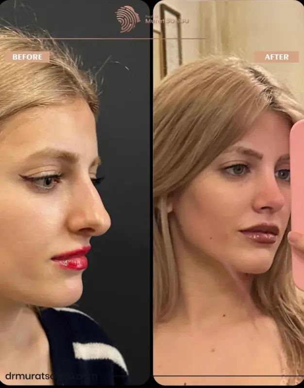 تجميل الأنف الأساسي قبل وبعد مقارنة قبل وبعد لتجميل الأنف لامرأة شابة شقراء تُظهر تحسن الملامح الجانبية للأنف، وجسرًا أكثر نعومة، وشكل أنف أكثر دقة على يد اختصاصي الجراحة التجميلية البروفيسور الدكتور مراد سونغو