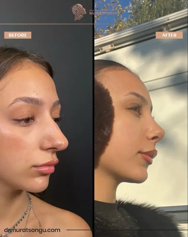 تجميل الأنف الأساسي قبل وبعد مقارنة قبل وبعد لتجميل الأنف للمنظر الجانبي لامرأة شابة، تُظهر تحسن شكل الأنف، وجسرًا أنفيًا أكثر نعومة، وطرفًا أكثر دقة على يد الدكتور مراد سونغو