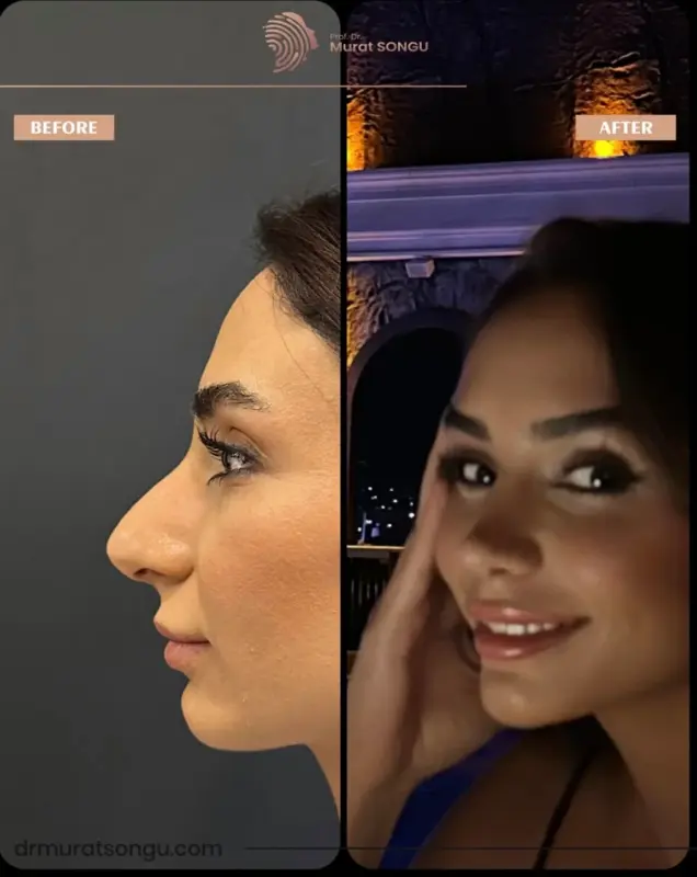 تجميل الأنف الأساسي قبل وبعد مقارنة قبل وبعد لتجميل الأنف تُظهر إعادة تشكيل أنف امرأة من المنظر الجانبي على يد البروفيسور الدكتور مراد سونغو، مع إبراز تحسن محيط الأنف وتناسق الوجه بعد جراحة الأنف التجميلية
