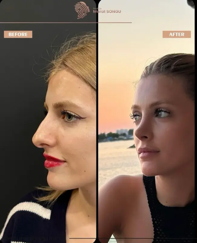 تجميل الأنف الأساسي قبل وبعد مقارنة قبل وبعد لتجميل الأنف تُظهر المنظر الجانبي لامرأة مع شكل أنف أكثر دقة واستقامة وتناسق وجهي مُحسّن بعد جراحة الأنف التجميلية