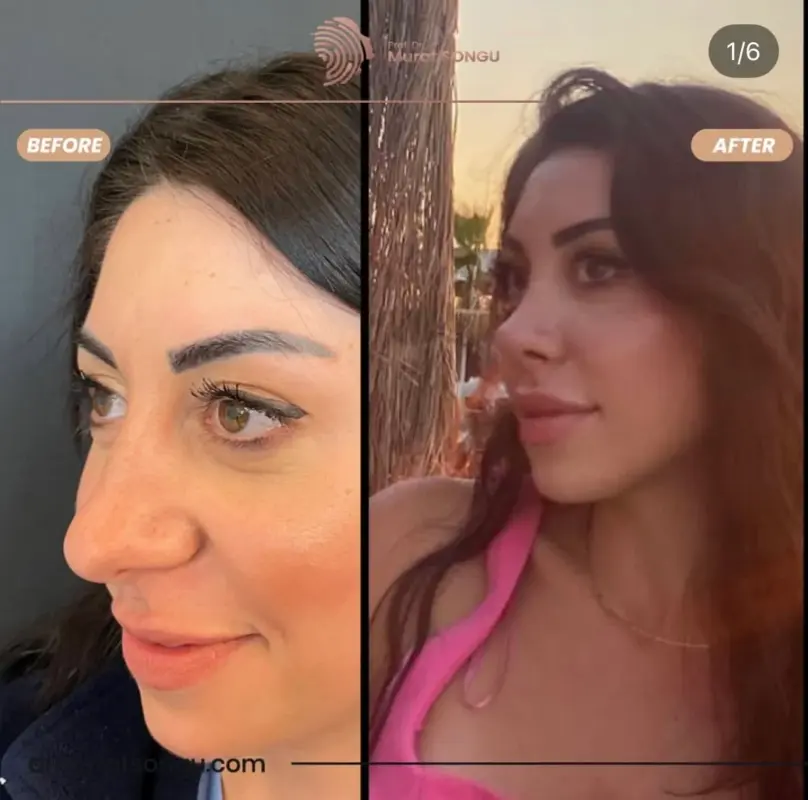 تجميل الأنف الأساسي قبل وبعد مقارنة قبل وبعد لتجميل الأنف تُظهر تحسن الملامح الجانبية للأنف وتناسق الوجه لدى مريضة