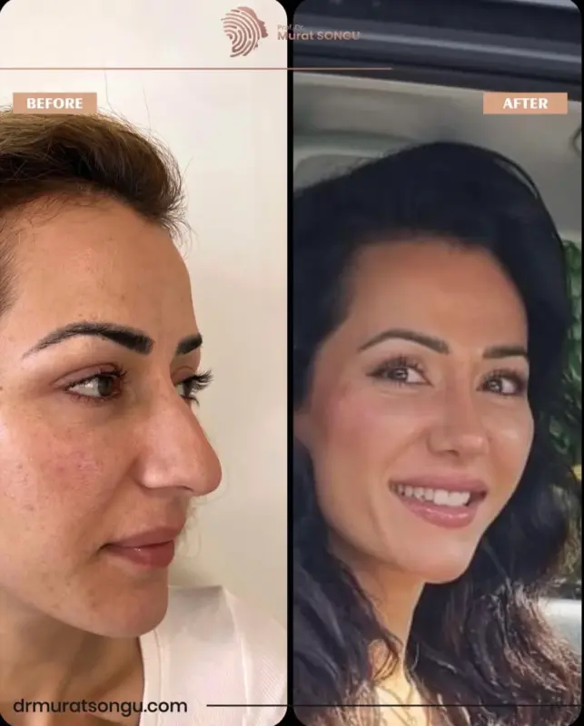 تجميل الأنف الأساسي قبل وبعد نتائج تجميل الأنف قبل وبعد لامرأة تُظهر تصحيح الأنف من المنظر الجانبي وتحسن تناسق الوجه، أُجريت على يد البروفيسور الدكتور مراد سونغو