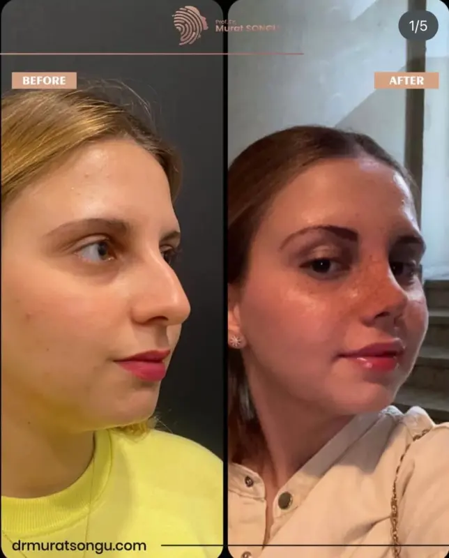 تجميل الأنف الأساسي قبل وبعد نتائج تجميل الأنف قبل وبعد تُظهر تحول المنظر الجانبي لامرأة شابة، مع إبراز جسر أنفي أكثر نعومة وشكل أنف أكثر دقة على يد البروفيسور الدكتور مراد سونغو