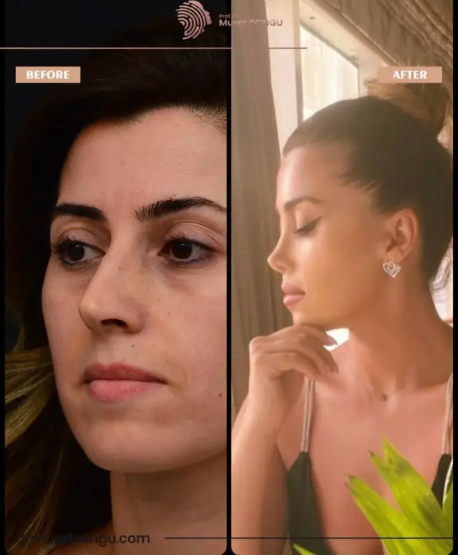 تجميل الأنف الأساسي قبل وبعد نتائج تجميل الأنف قبل وبعد تُظهر تحسن الملامح الجانبية للأنف وتناسق الوجه لدى مريضة، في مقارنة جنبًا إلى جنب