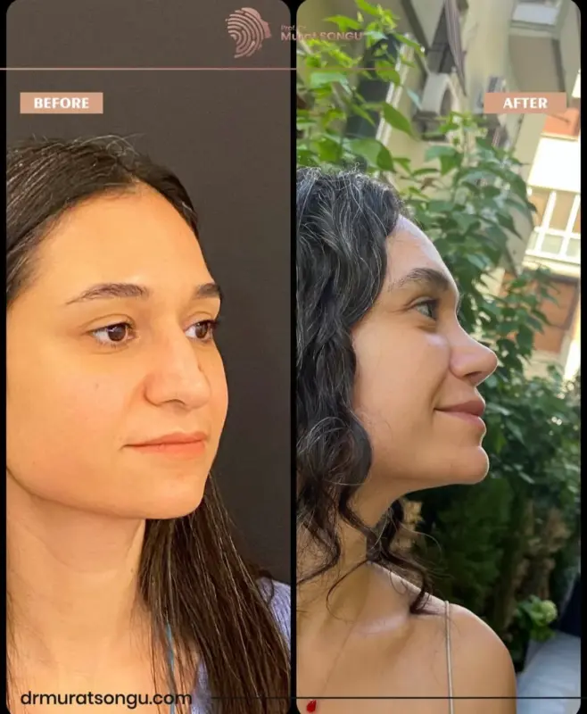 تجميل الأنف الأساسي قبل وبعد نتائج تجميل الأنف قبل وبعد تُظهر تحسن المنظر الجانبي لمريضة على يد الدكتور مراد سونغو