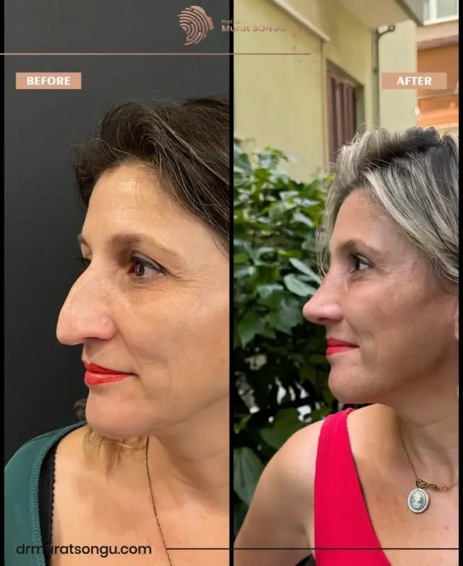 تجميل الأنف الأساسي قبل وبعد نتائج تجميل الأنف قبل وبعد تُظهر المنظر الجانبي لامرأة في منتصف العمر، مع إبراز تحسن شكل الأنف، وجسر أنفي أكثر دقة، وتناسق وجهي مُحسّن على يد الدكتور مراد سونغو