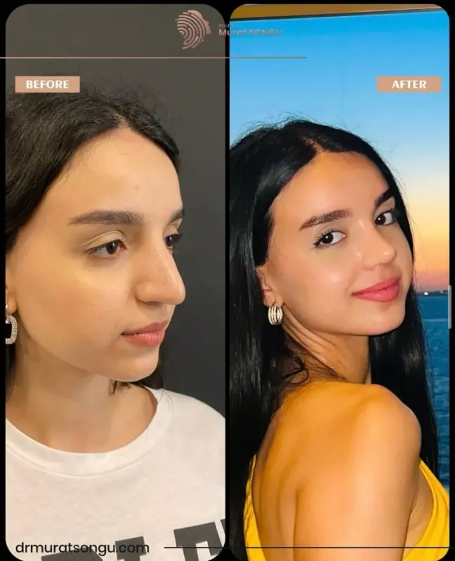 تجميل الأنف الأساسي قبل وبعد نتائج تجميل الأنف قبل وبعد تُظهر تحول المنظر الجانبي لامرأة شابة مع تحسن شكل الأنف وتناسق الوجه على يد الدكتور مراد سونغو