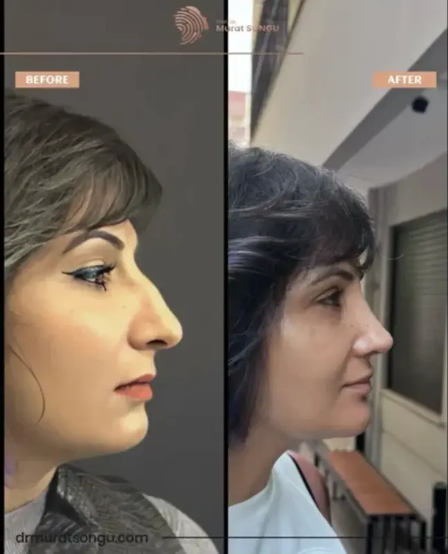 تجميل الأنف الأساسي قبل وبعد مقارنة جانبية قبل وبعد لتجميل الأنف لامرأة تُظهر نتائج إعادة تشكيل الأنف، وجسرًا أنفيًا أكثر نعومة، وتحسن تناسق الوجه على يد الدكتور مراد سونغو