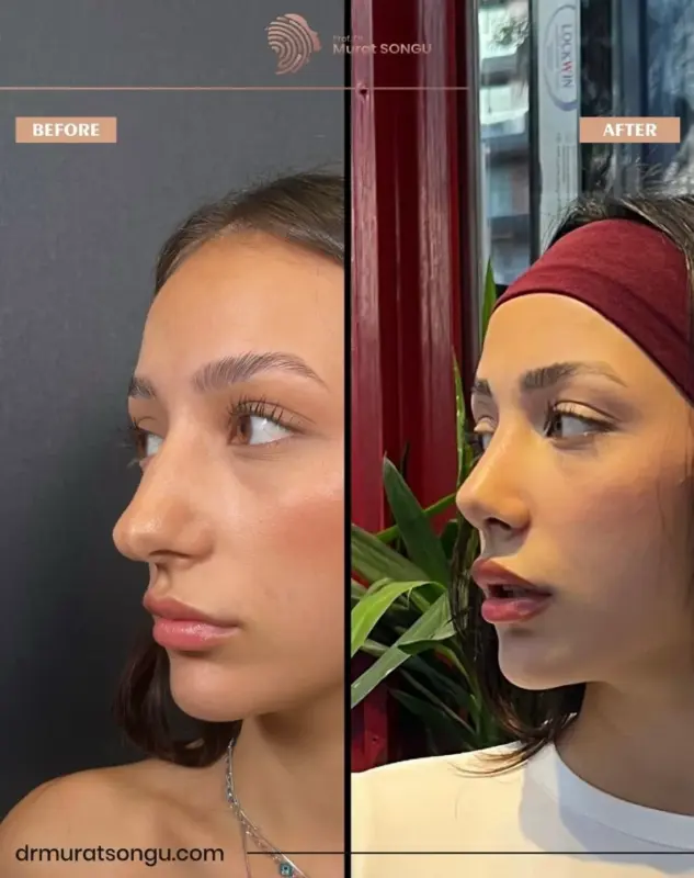 تجميل الأنف الأساسي قبل وبعد مقارنة جانبية قبل وبعد لتجميل الأنف لامرأة شابة، تُظهر تحسن شكل الأنف وجسرًا أنفيًا أكثر دقة على يد الدكتور مراد سونغو
