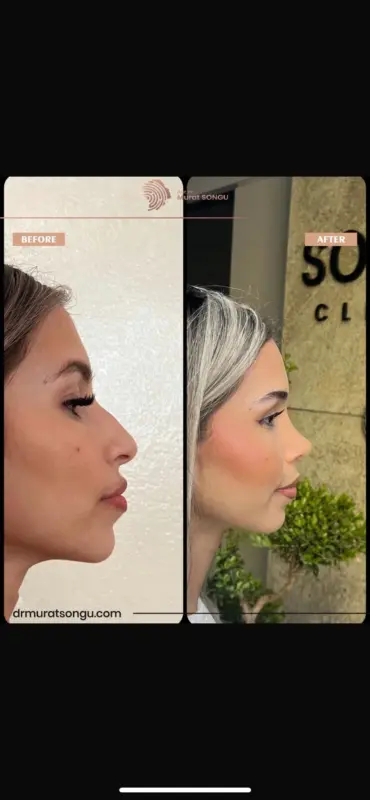 تجميل الأنف الأساسي قبل وبعد مقارنة جانبية قبل وبعد لتجميل الأنف لامرأة شابة تُظهر تقليل حدبة الأنف، وصقل طرف الأنف، وتحسن تناسق الوجه، أُجريت على يد الدكتور مراد سونغو