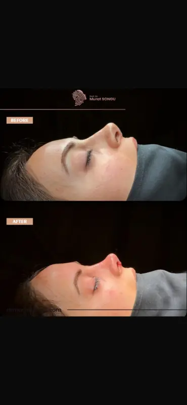 تجميل الأنف الأساسي قبل وبعد منظر جانبي قبل وبعد لتجميل الأنف لامرأة شابة يُظهر تحسن شكل الأنف وارتفاع طرف الأنف، أُجري على يد البروفيسور الدكتور مراد سونغو