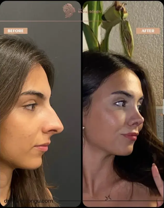 تجميل الأنف الأساسي قبل وبعد منظر جانبي قبل وبعد لتجميل الأنف لامرأة شابة يُظهر تحسن شكل الأنف، وجسرًا أنفيًا أكثر نعومة، وطرفًا أكثر دقة من أجل تحسين تناسق الوجه
