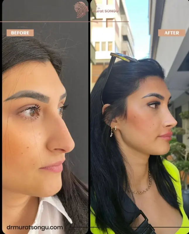 تجميل الأنف الأساسي قبل وبعد منظر جانبي قبل وبعد لامرأة يُظهر نتائج تجميل الأنف، مع أنف أكثر دقة واستقامة في الصورة بعد الإجراء