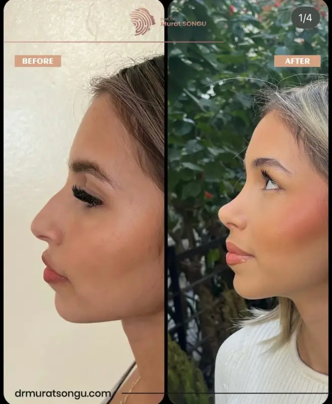 تجميل الأنف الأساسي قبل وبعد منظر جانبي قبل وبعد لامرأة يُظهر نتائج تجميل الأنف مع شكل أنف أكثر دقة وارتفاعًا وتحديد أكثر نعومة للوجه
