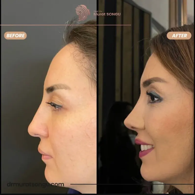 تجميل الأنف الأساسي قبل وبعد منظر جانبي قبل وبعد لامرأة يُظهر نتائج تجميل الأنف، مع شكل أنف أكثر نعومة ودقة وملامح جانبية للوجه أكثر تحسينًا