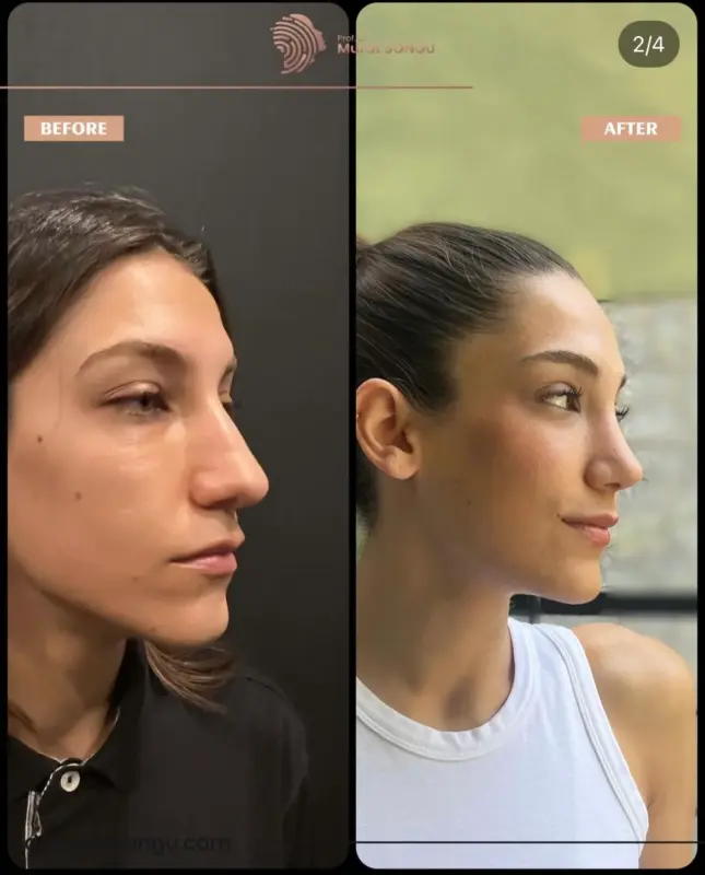 تجميل الأنف الأساسي قبل وبعد مقارنة تجميل الأنف قبل وبعد لامرأة شابة تُظهر إعادة تشكيل الأنف من الجانب، وتحسن جسر الأنف، وصقل طرفه على يد البروفيسور الدكتور مراد سونغو