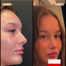 Barbie Nose Rhinoplasty Result Barbie Nose Rhinoplasty Result