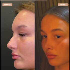 Barbie Nose Rhinoplasty Result Barbie Nose Rhinoplasty Result